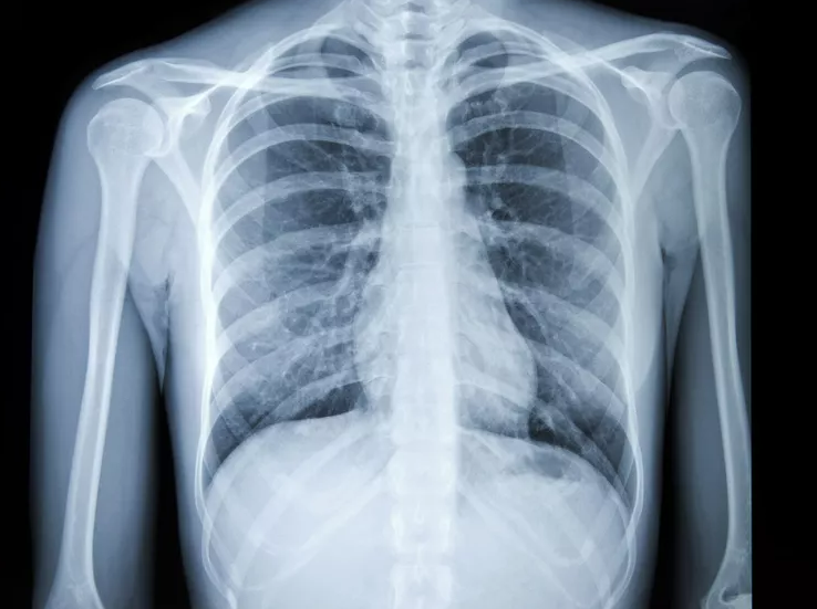 Chest X-Ray Lung Disease Detection